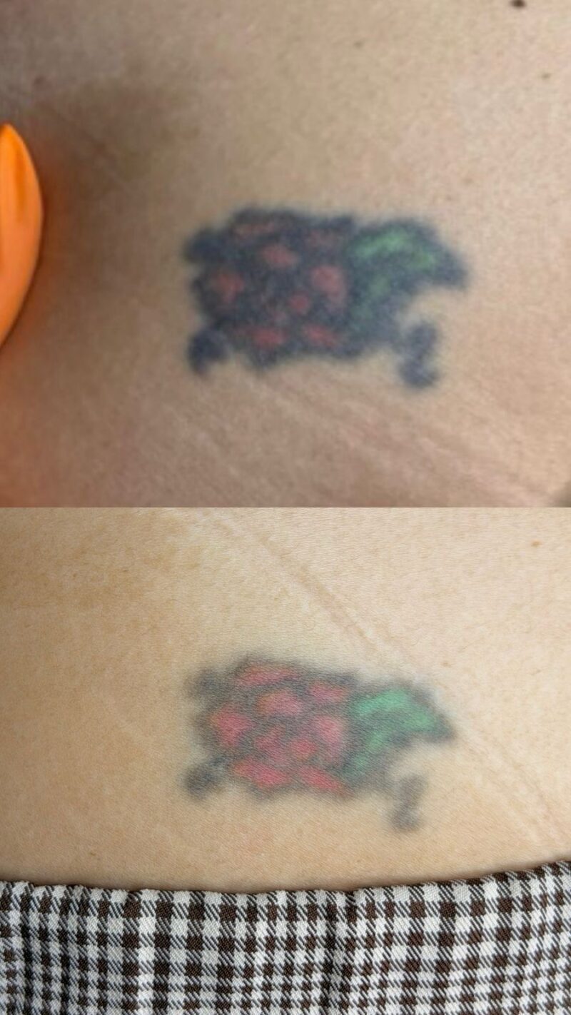 Remoção de tatuagem a laser: como funciona