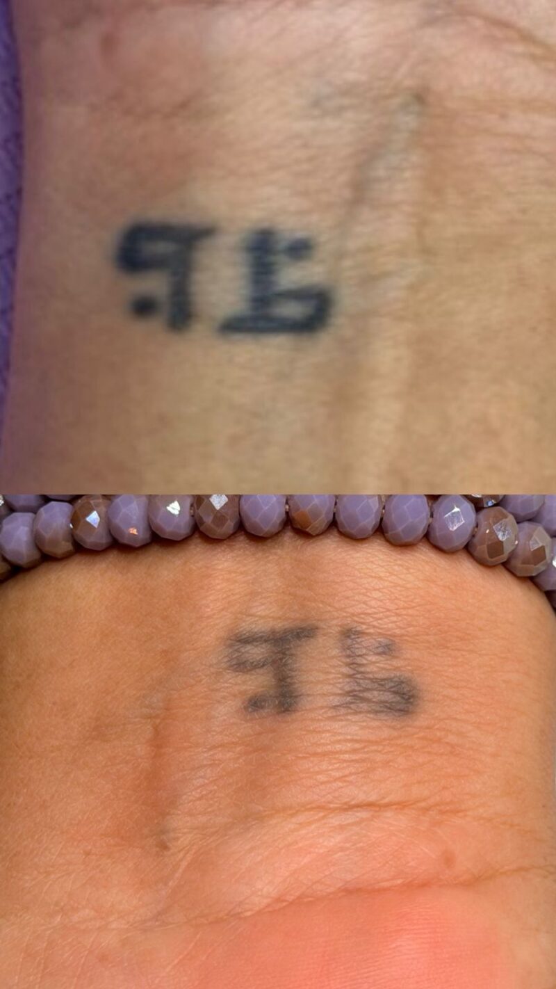 Remoção de tatuagem a laser: como funciona