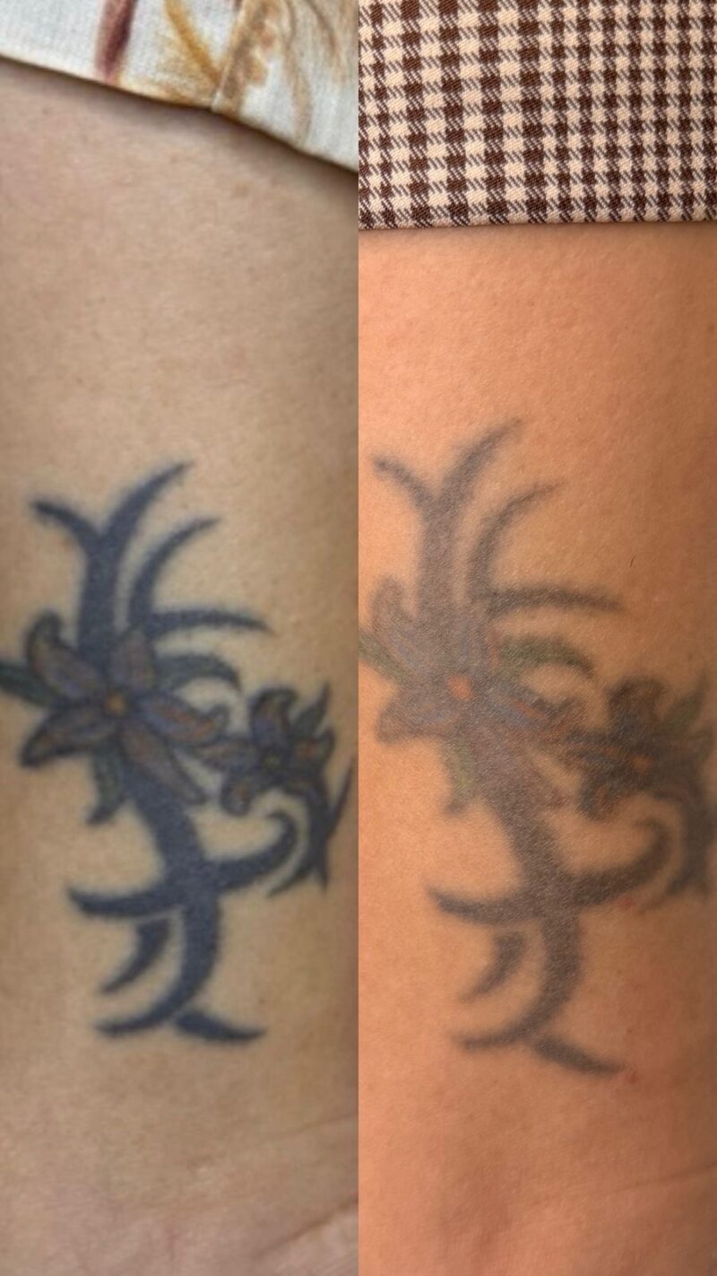 Remoção de tatuagem a laser: como funciona